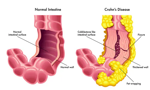 Crohn's Disease