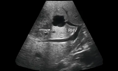 The use of ultrasound in liver metastasis surgery