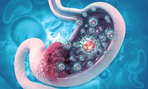 Gastrointestinal Stromal Tümörler (GİST)