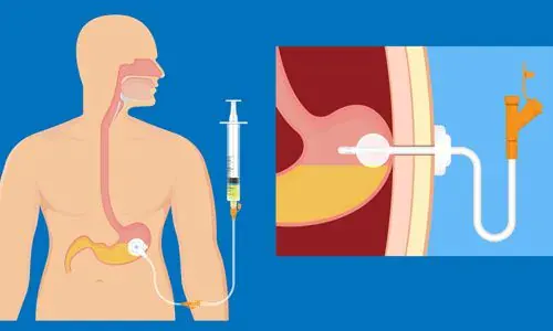 Gastrostomi (PEG) İşlemi