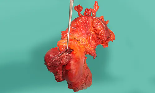 Rectosigmoid cancer removed with uterus and ovaries