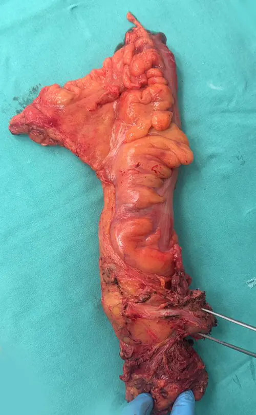 Rectum cancer removed with prostate