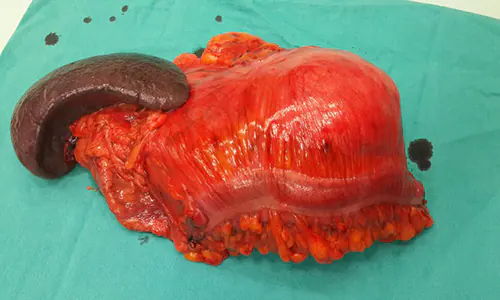 In a case of retroperitoneal sarcoma, spleen, pancreas, tail, left colon and kidney were removed.