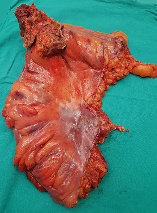 Sigmoid colon cancer removed with abdominal wall