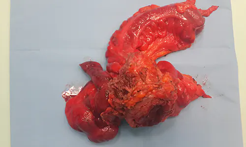 Sigmoid colon cancer removed with bladder and abdominal wall